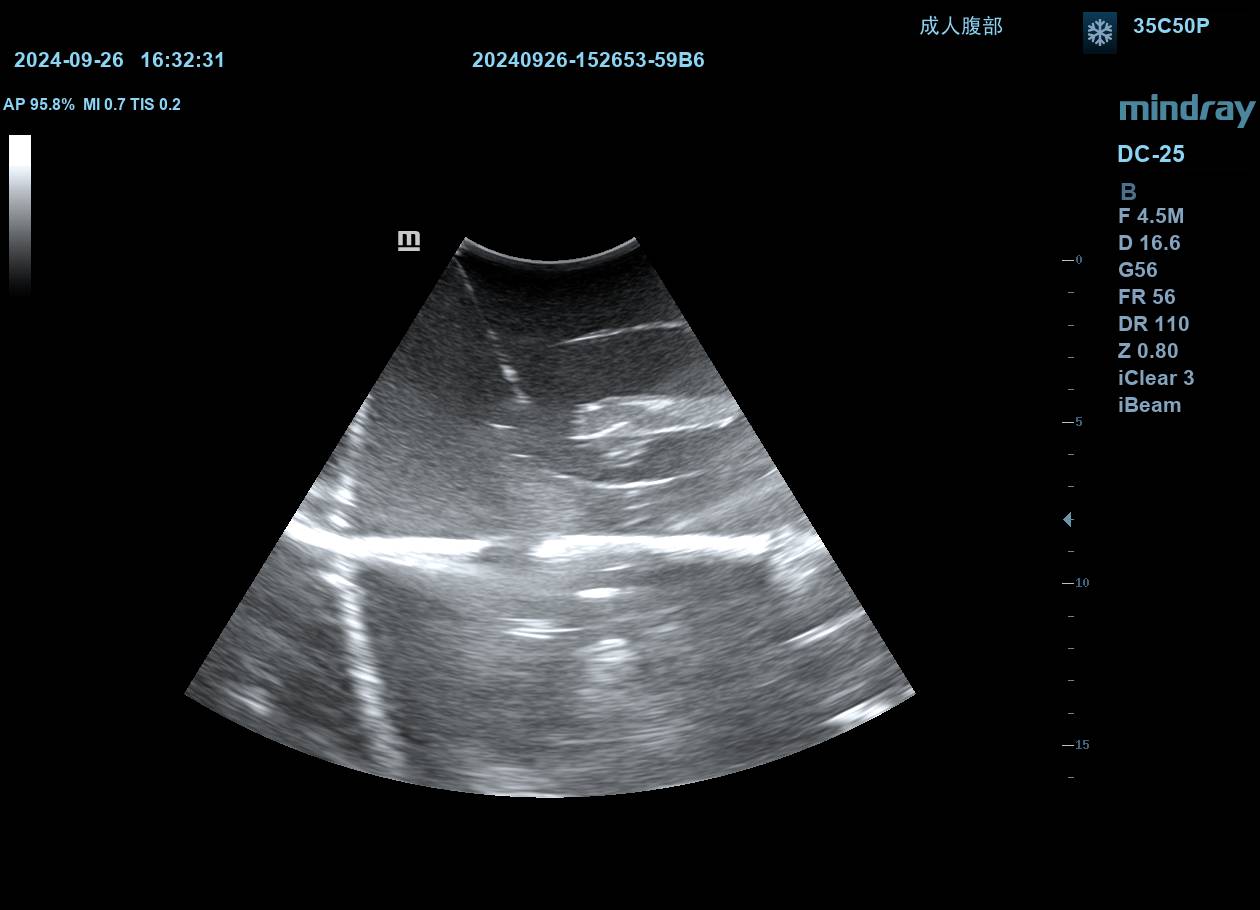 Renal Biopsy Ultrasound Training Model