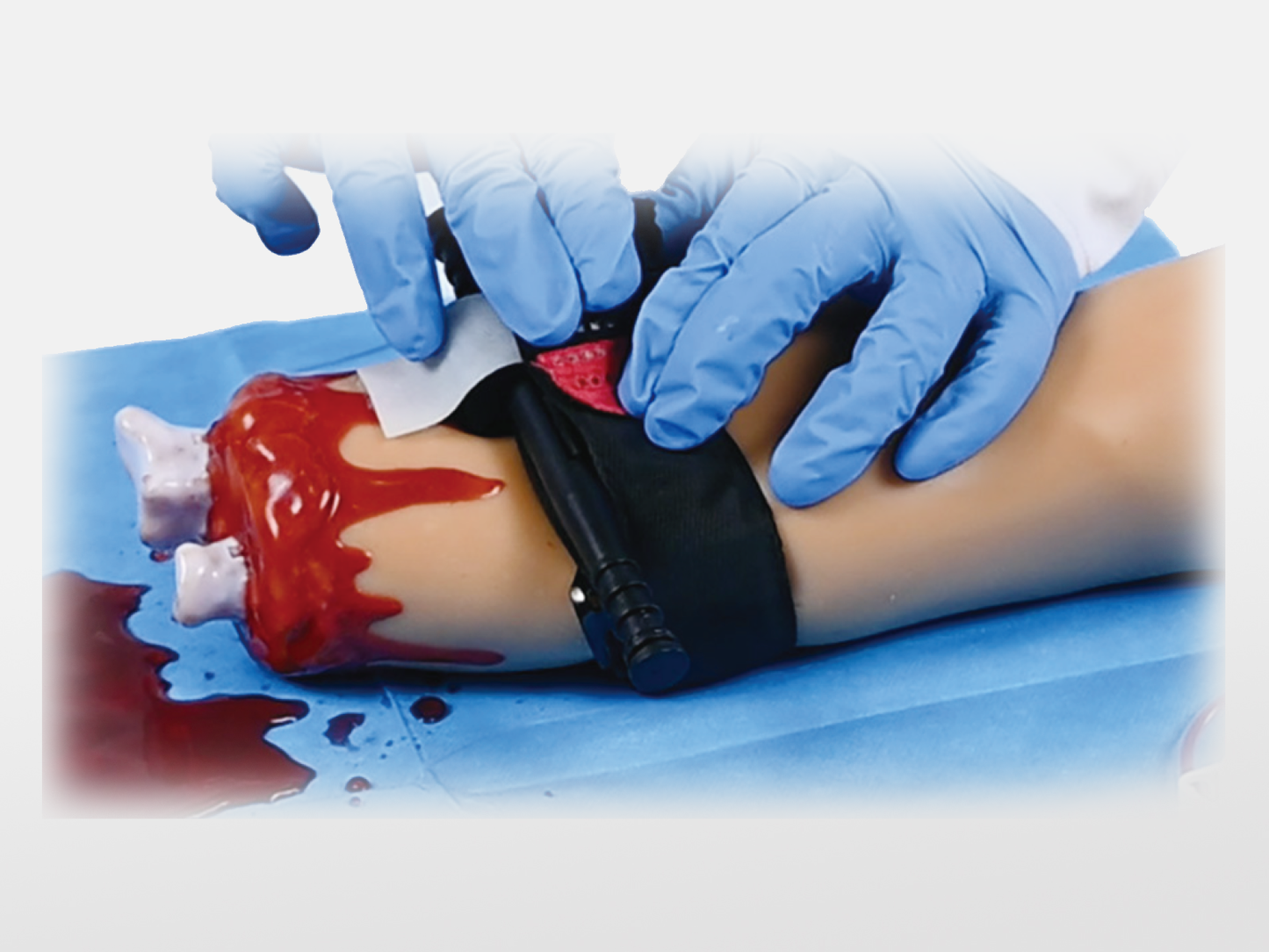 Amputation and Trauma Bleeding Arm